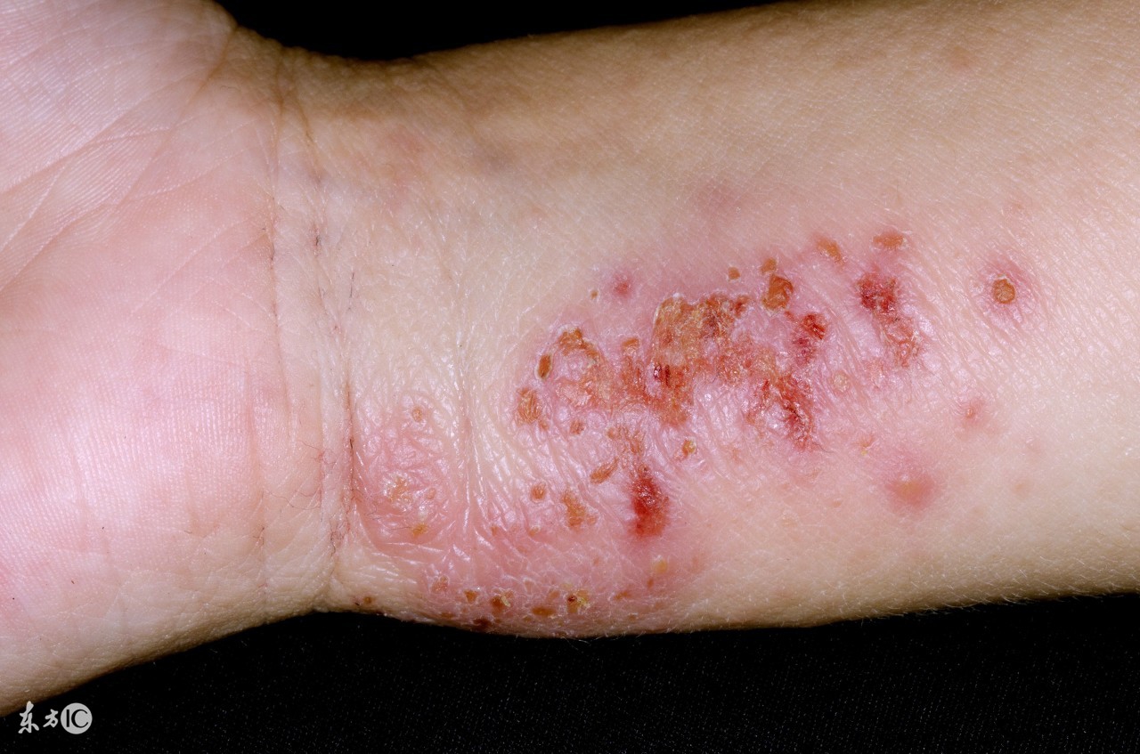 糖尿病皮肤病变患者如何自我调护