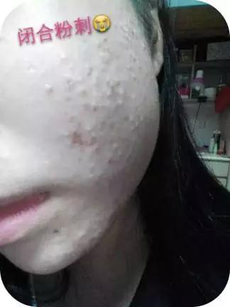 痘痘类皮肤的护理方法有哪些,痘痘肌肤的8个护理方式