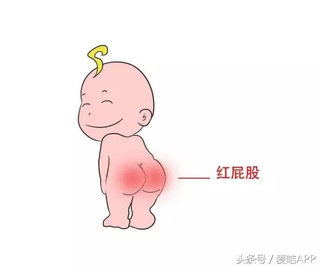 CTY：尿布疹原因及症状与多效修复凝胶治疗护理方式！