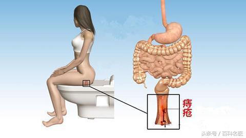 得了痔疮是什么感受疼不疼,得痔疮的亲身经历