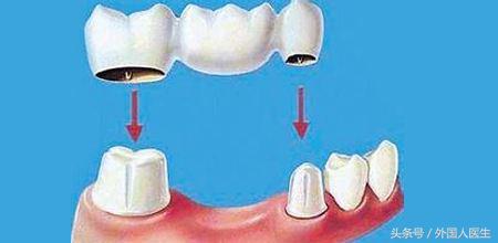 国外人牙齿掉了怎么处理,外国人牙齿掉了怎么办