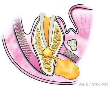 牙龈处长了不疼的小包,牙龈上起了一个小肉包的图片