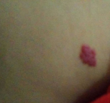 宝妈胎记,胎记你们的宝宝有吗