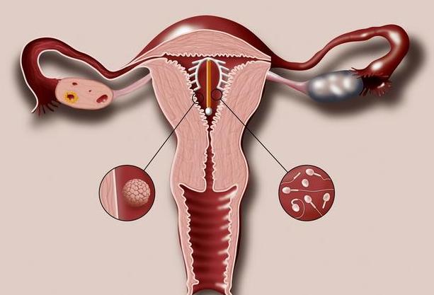 “上环”后月经一直不正常，取环却发现已崁入子宫