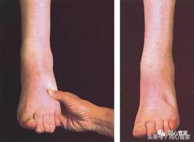 大盘点！支架术后最常见的9大症状，你中招了几条？