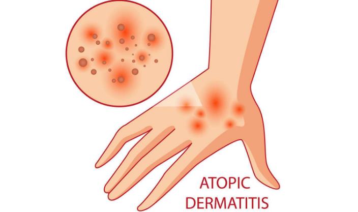 脂溢性皮炎皮肤红彤彤的怎么治,脂溢性皮炎又红又痒