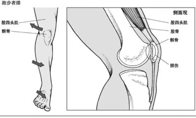 膝关节髌骨疼痛的治疗,髌骨关节疼痛怎么回事