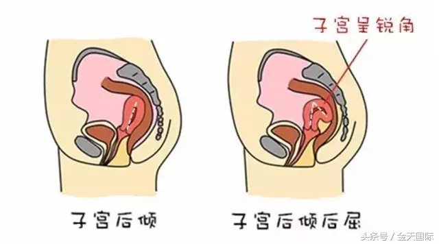 别再这样做！这些动作会导致女人子宫移位！