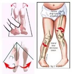 外八字脚可以调理过来吗,外八字脚好不好