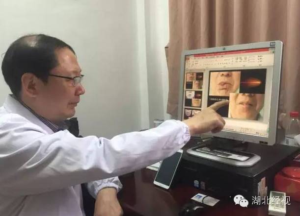 嘴唇肿块是癌症的前兆,嘴唇旁边长一个肿瘤怎么办