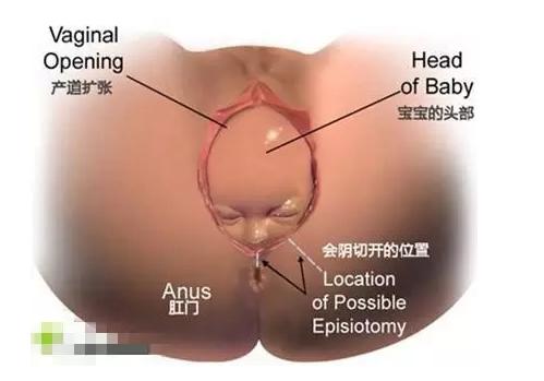 生孩子一定要外阴侧切吗,顺产要做阴侧切吗