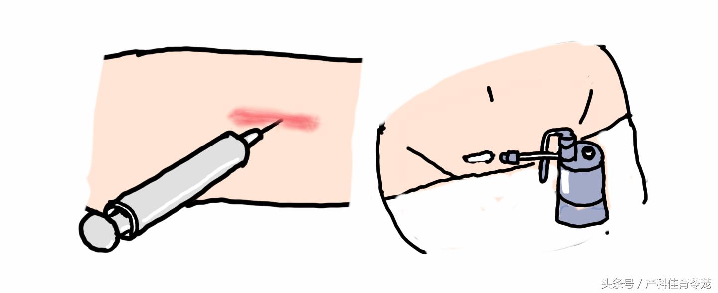 剖宫产疤痕开始痒怎么缓解,剖宫产后预防瘢痕的小技巧