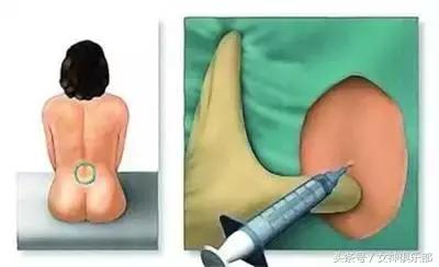 无痛分娩后期会腰痛吗,无痛分娩后期有危险吗