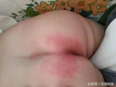 宝宝红屁股因为什么,什么牌子纸尿裤可以预防红屁股