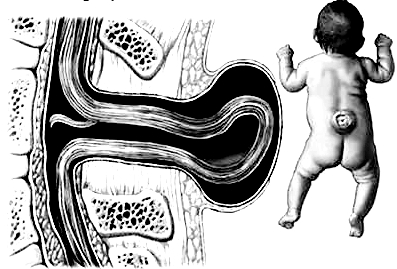 儿童12岁隐性脊柱裂尿床能自愈吗,儿童骶1椎体隐性脊柱裂手术