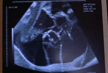 宝宝胎动突然踢一下,宝宝胎动好大力被踢出来