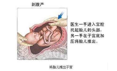经历了剖腹产才知道妈妈的不容易,看了剖腹产才明白妈妈是多么伟大