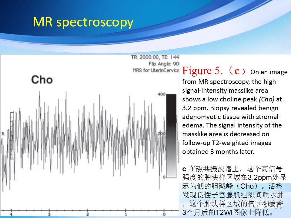 双语PPT：子宫腺肌症常见和不常见的MRI表现医学影像