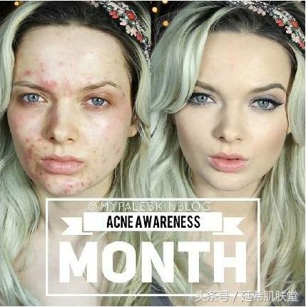 “你如果不长痘一定很好看”——长痘患者的自述