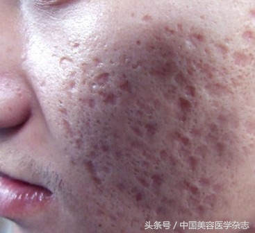 痘坑怎么修复最好方法,痘坑如何形成的怎么治疗
