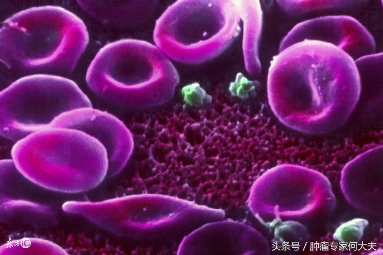 确诊是淋巴瘤要怎么办,淋巴瘤是怎样的血液病