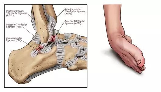 打篮球崴脚之后怎么防止再次崴脚,篮球怎么减少崴脚