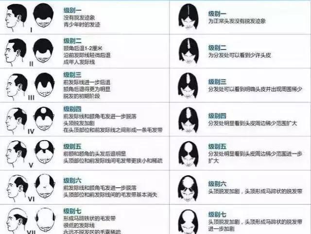 拯救发际线是什么意思,脂溢性脱发发际线稀疏怎么拯救