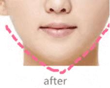 瘦脸针一次效果明显吗,瘦脸针七天效果不明显