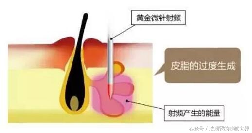 月球表面痘坑最佳治疗,月球表面怎么祛痘印