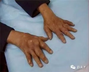 痛风中医讲座,教你一招根治痛风