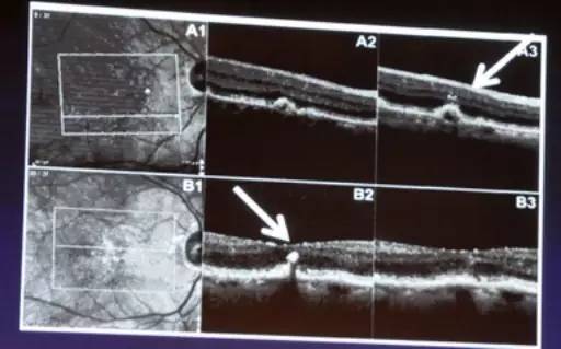 COFDS2016KarlG.Csaky：视网膜色素上皮脱离在干性AMD进展中的影响