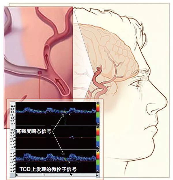 缺血性卒中静脉溶栓指南2022,预防血栓利器