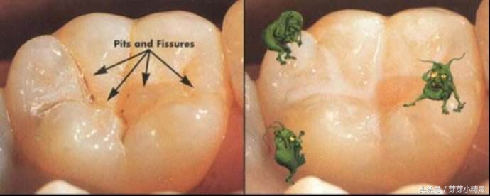 窝沟封闭注意事项,虫牙可以做窝沟封闭吗
