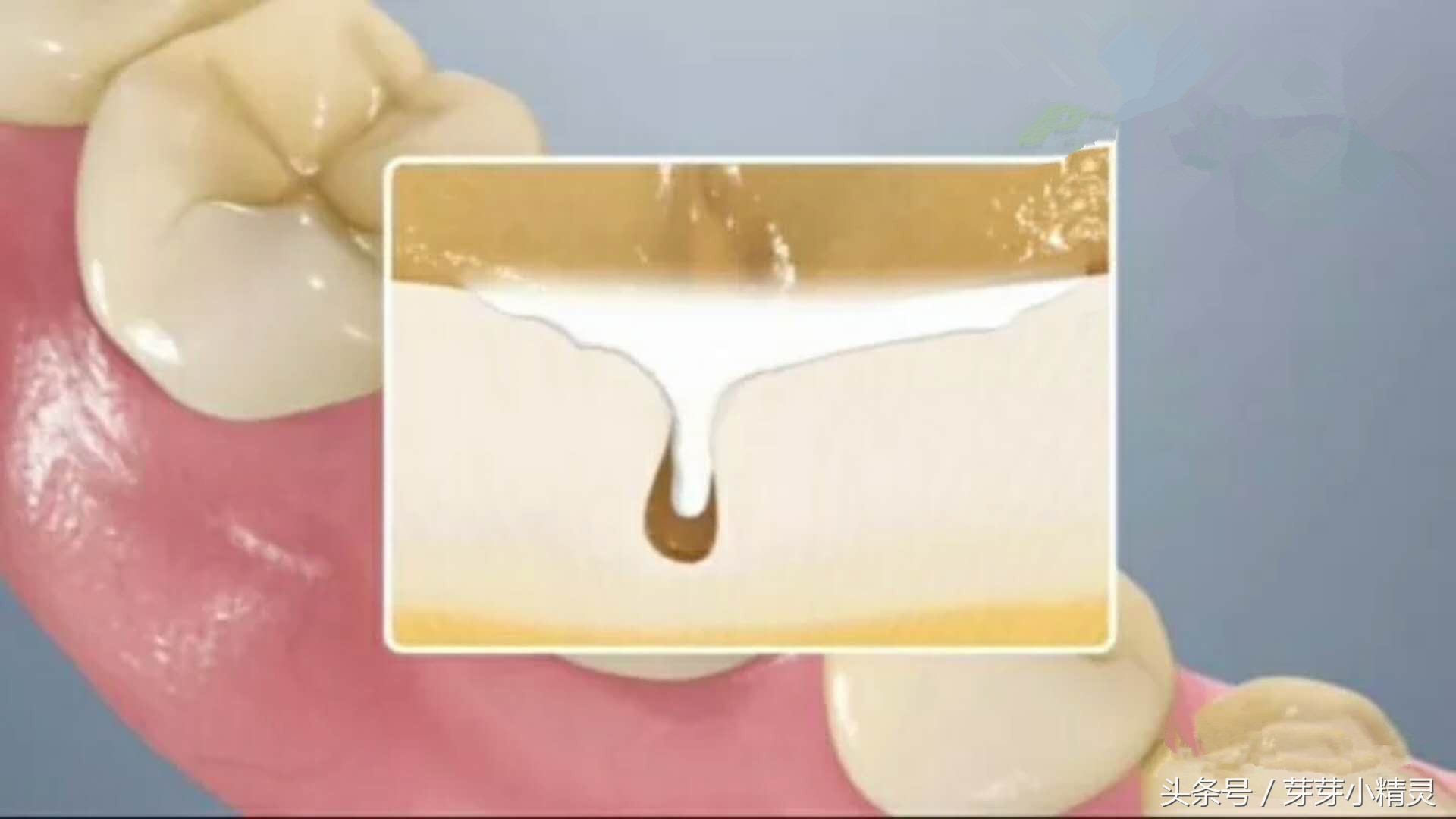 窝沟封闭注意事项,虫牙可以做窝沟封闭吗