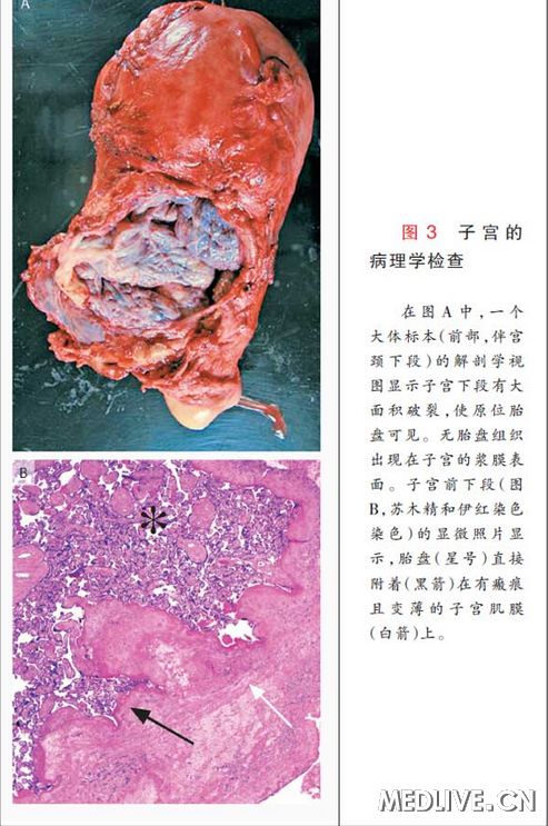 胎盘不正,孕妇因宗教信仰拒绝输血,如何解决?