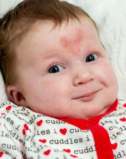 胎记的意义是什么,脚踝长胎记有什么意义