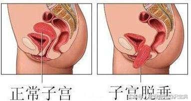 25岁孕妈顺产40天后，莫名垂下“一坨肉”，医生检查后告知来晚了