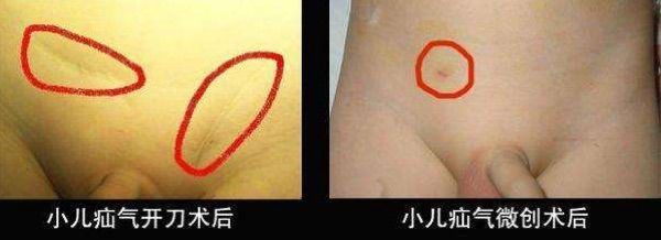 西乡县县医院小儿疝气手术,太和医院疝气微创手术