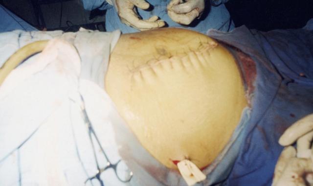 剖腹产产妇从产房出来有什么流程,刚剖腹产出来的小孩一惊一乍的