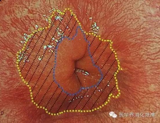 barrett食管的症状是什么,barrett食管是什么意思