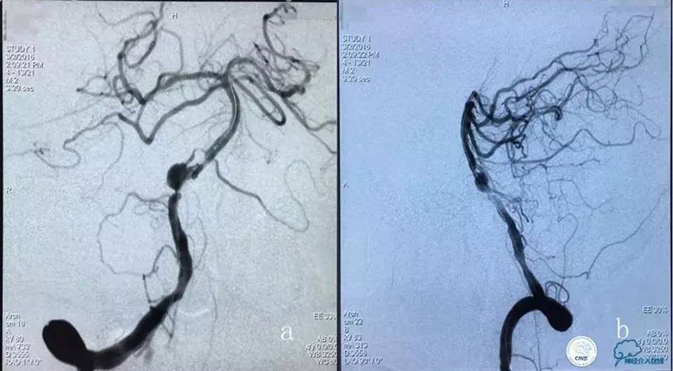 脑动脉瘤并颈动脉狭窄怎么治疗,脑动脉血管狭窄介入治疗效果好吗