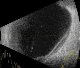 脉络膜上腔出血是怎样的症状,自发性蛛网膜下腔出血的临床表现