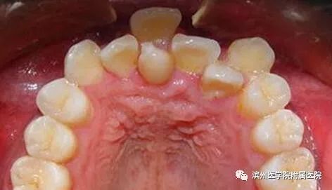 小孩的牙齿过长牙缝过大怎么办,牙齿有牙缝对孩子有影响吗