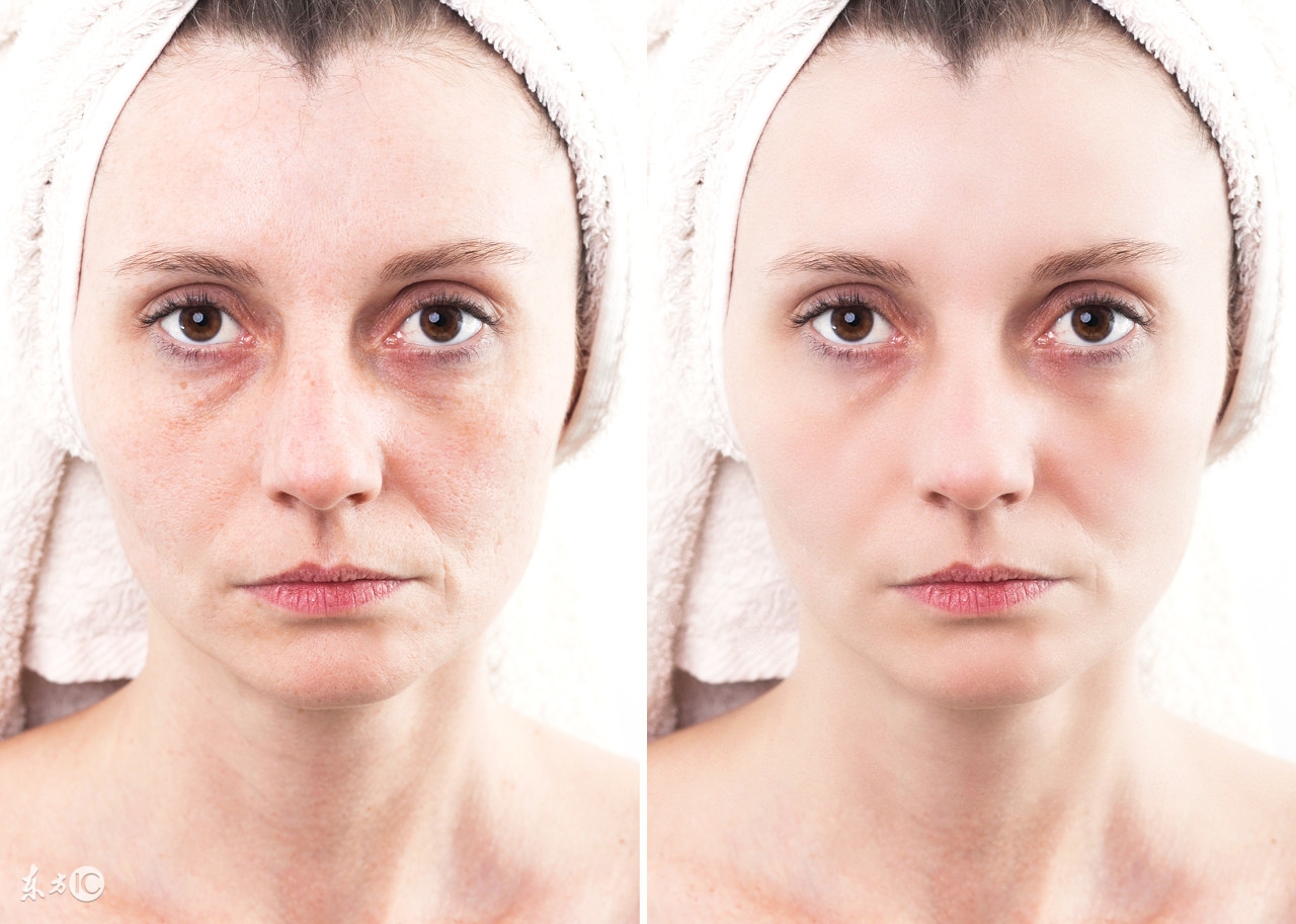 毛孔粗大怎么办怎么有效收缩毛孔,毛孔堵塞粗大怎么快速解决