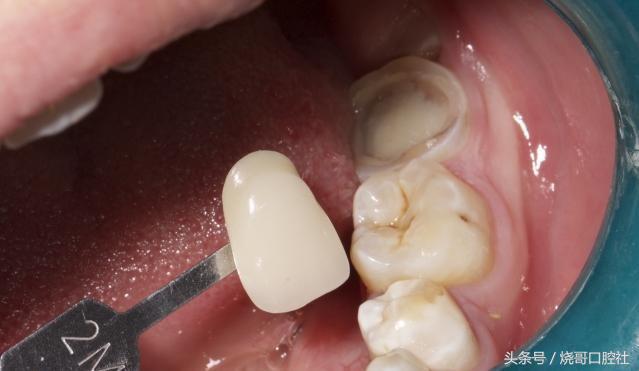 牙齿做牙冠哪种材料好,牙冠材料的种类及优缺点