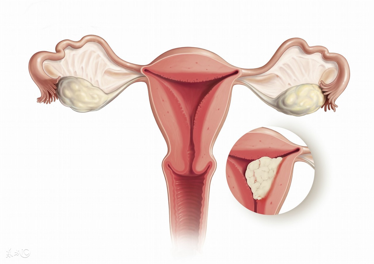 怎样预防母猪子宫内膜炎,猪产后怎么预防子宫内膜炎