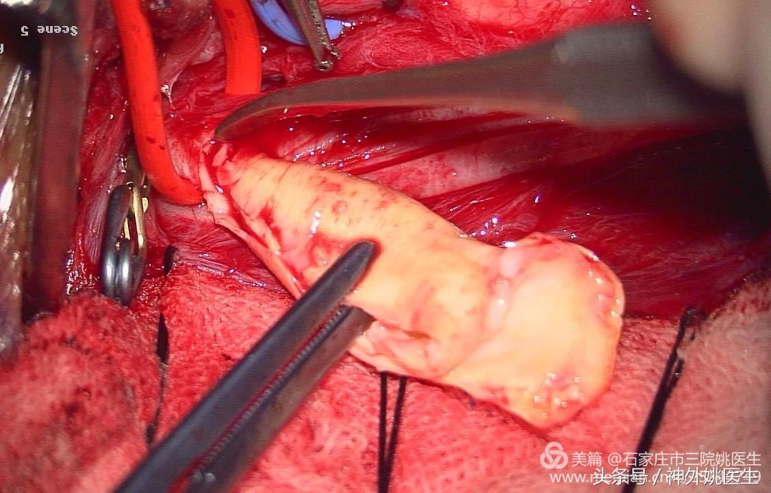 颈内动脉狭窄可以做内膜剥脱术吗,颈内动脉内膜剥脱手术指征