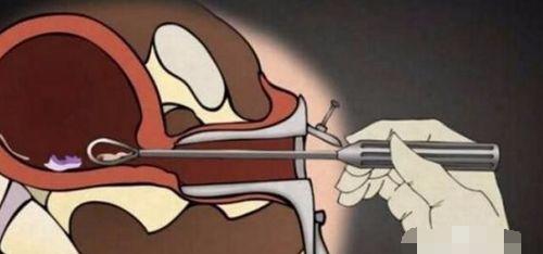 堕胎时人类是怎样一步步杀死自己孩子的?妈妈会看哭!