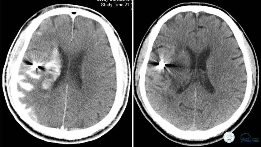 颅内动脉狭窄介入治疗研究,颅内血管cta副作用