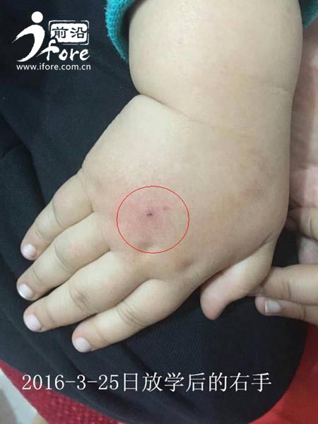 塔元庄幼儿园老师针扎幼童,红黄蓝幼儿园针扎幼童